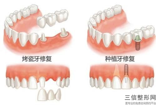 柳州成人雙尖牙根管適用的人群是哪些