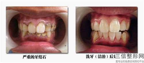 陳秀蕓前牙全瓷固定橋修復后遺癥如何修復