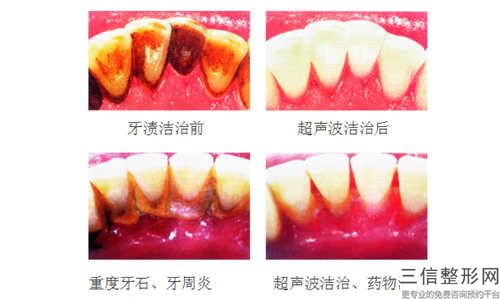 德宏根尖牙齒手術之后會出現哪些不良反應