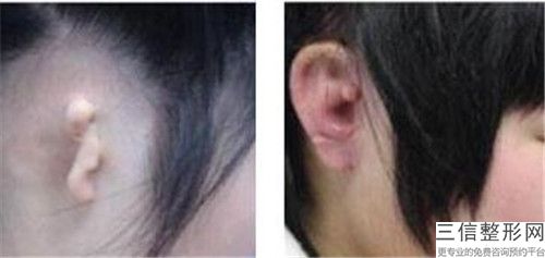 拉本整形集團小耳廓畸形之后的護理有哪些