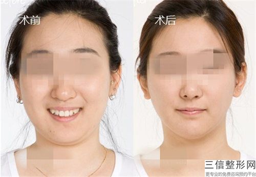 伊犁做雙下巴抽脂可保持的時間有多久