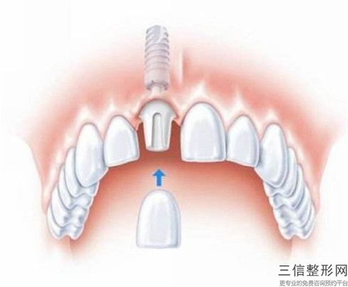 西南整形美容專(zhuān)科醫(yī)院?jiǎn)稳藰s耀全瓷牙套餐手術(shù)的安全性有多高