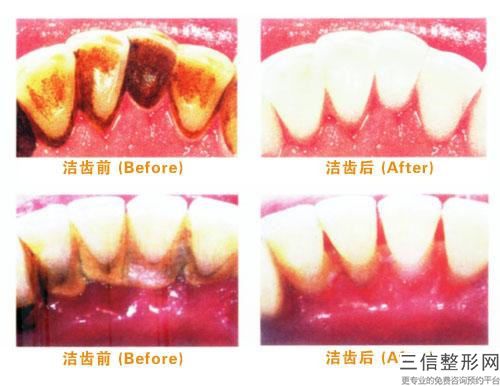 滁州emax牙齒嵌體術的人群有哪些