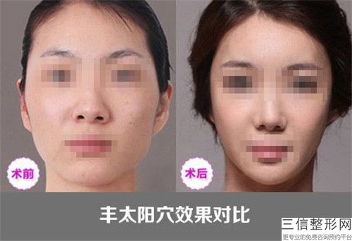 朱曉浩 玻尿酸充填蘋(píng)果肌比較長(zhǎng)能管多久