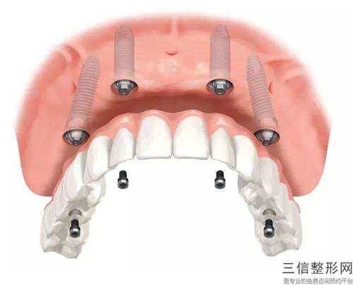 新余全瓷牙單冠過程是怎樣的有沒有副作用