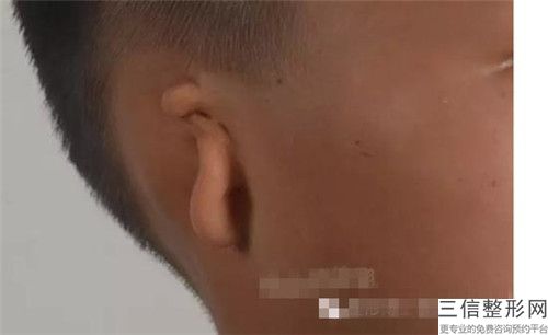 南平耳再造直埋費用介紹_南平耳再造直埋手術的價格及效果如何