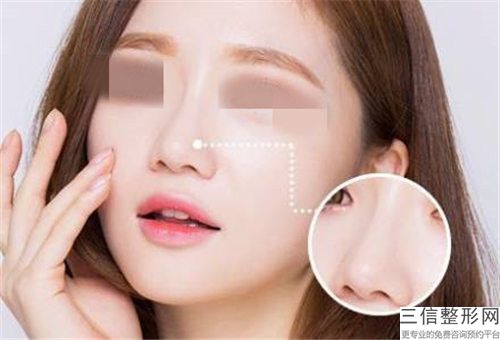 ***做手術縮小鼻翼醫院推薦：做手術縮小鼻翼醫院前20重點介紹