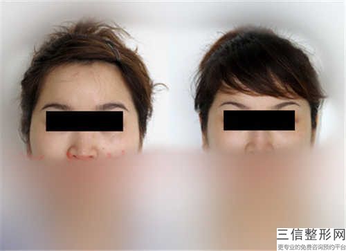 贛州何勤口腔診所下頜埋伏阻生智齒術(shù)后護(hù)理事項(xiàng)是什么