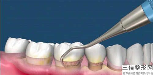 岳陽種牙微創(chuàng)手術有哪些壞處呢