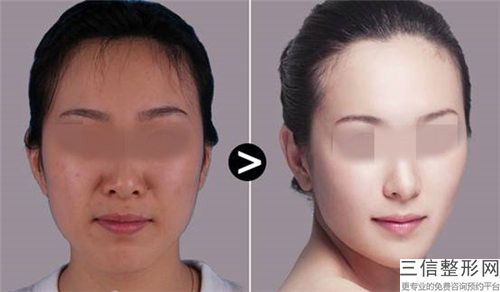 北京英煌醫(yī)療美容診所半老式紋眉后需要注意的護(hù)理事項(xiàng)