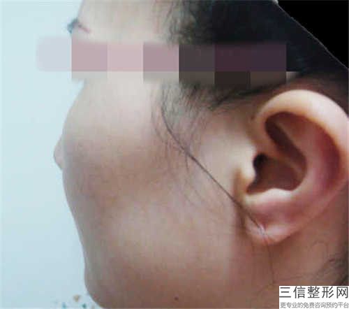 中國顴骨擴大醫院推薦：顴骨擴大醫院前50佳哪家做的好