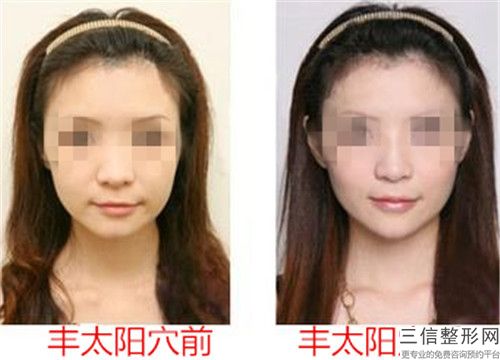 南充脂肪豐蘋果肌術可保持多久時間