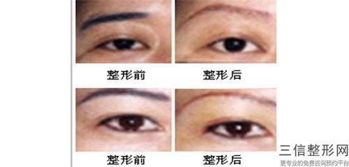 劉風卓眉毛移植手術的副作用及注意事項