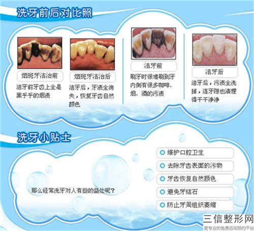 大連拜博口腔醫(yī)院全口拓美種植牙術可以維持多久如何護理