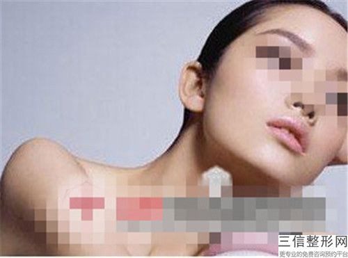 賈美樂耳畸形直埋手術(shù)術(shù)怎么樣可以維持多久