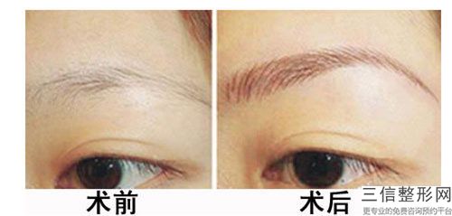 酒泉Z成形法眉位不正整形手術怎么保證安全