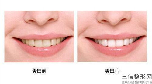 許昌進(jìn)口可樂麗樹脂補(bǔ)牙通常要多少錢
