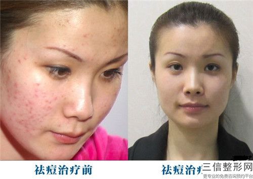 點(diǎn)陣激光去痘印會(huì)對(duì)人體產(chǎn)生副作用嗎