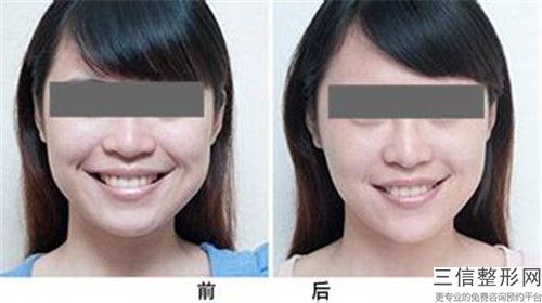 國字臉整形手術手術效果是長期的嗎