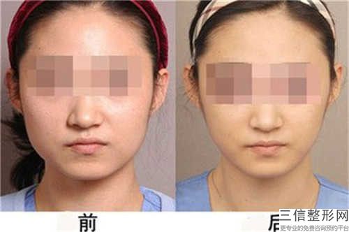 全國方臉削骨磨骨醫院推薦：方臉削骨磨骨醫院前50口碑相傳