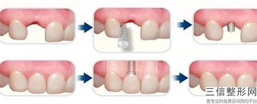 樁冠烤瓷牙整形手術(shù)的效果究竟如何