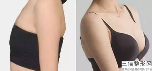 王寶芬整形醫生怎么樣醫生簡介_手術風格特色_乳頭整形比較案例
