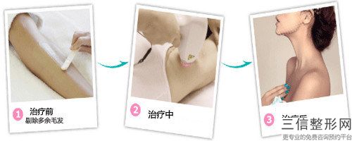 王輝整形醫(yī)生-嘉興市王輝醫(yī)生胳膊腿上汗毛去除負盛名