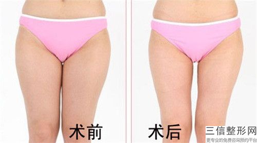 面部自體脂肪填充術(shù)對身體的副作用是什么