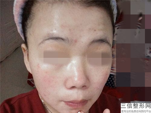 趙蓮英整形醫生點陣激光治療凸起痘疤實力前三無人能及-河北工程大學附屬醫院醫學美容整形外科