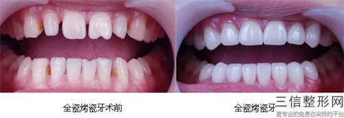 種植牙全景CT+檢查報(bào)告+方案設(shè)計(jì)做幾次能長久