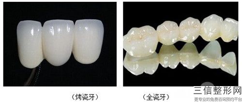 榆林后牙雙端固定橋整形的安全性怎樣