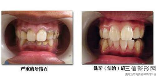 矯正牙齒牙弓后如何做好護理