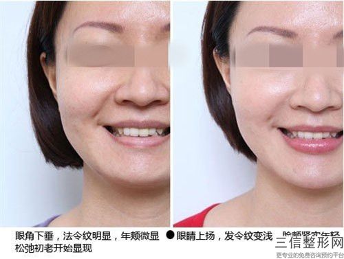 青銅峽市大壩衛(wèi)生院整形價格(收費標(biāo)準(zhǔn))詳情一覽-激光除皺去魚尾紋案例