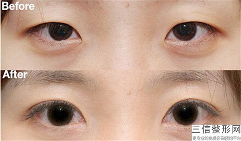 中國哪家整形醫院眼部重瞼術好：眼部重瞼術醫院前50佳明細分享