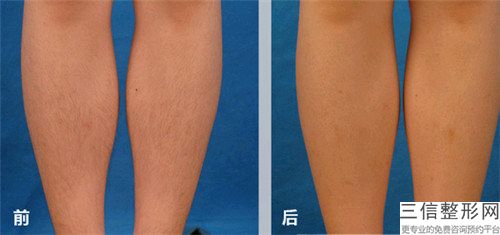 射頻美容會(huì)不會(huì)有副作用的發(fā)生呢
