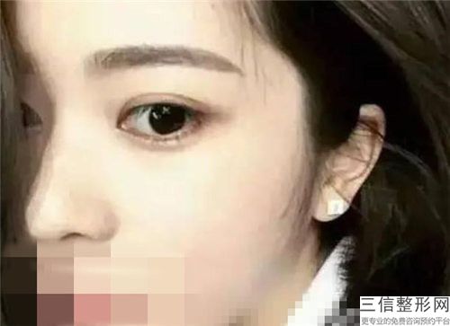 丹陽麗身華美醫(yī)療美容診所整形價格收費表剖析-線雕紋眉案例