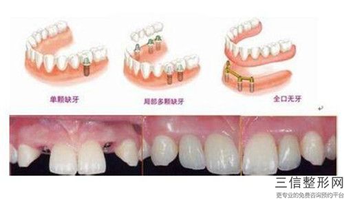 國內露牙齦正畸醫院推薦：露牙齦正畸醫院50強為您誠摯推薦