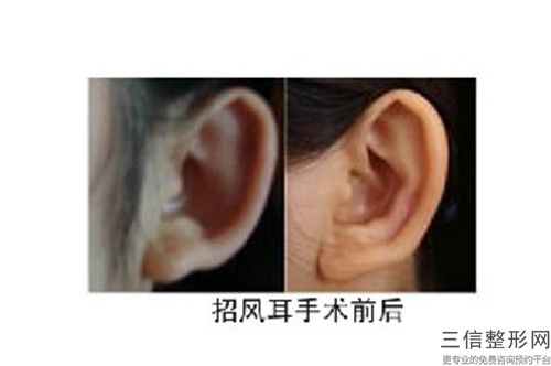 附耳切除整形術整形手術會存在危險嗎