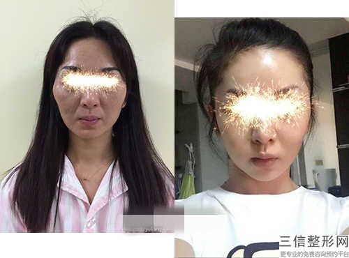 ***腳趾截骨手術醫院推薦：腳趾截骨手術醫院30強哪幾家更好