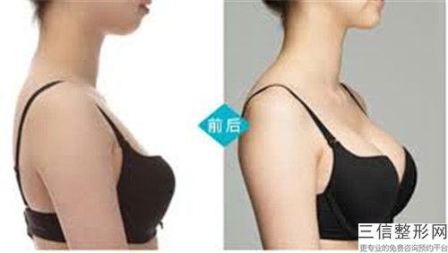 新鄉市乳腺再造價格表2024完整發布(近6個月均價為：29470元)