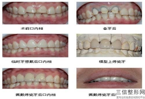 保山進口樹脂補牙手術常見風險和術后處理