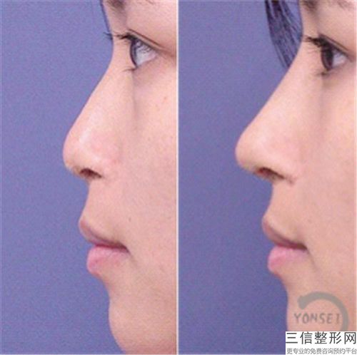 ***鼻梁骨整形手術(shù)醫(yī)院推薦：鼻梁骨整形手術(shù)醫(yī)院前30佳公立推薦