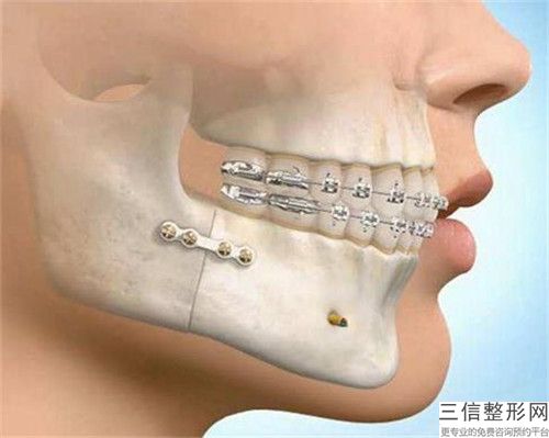 寶雞根管治療保留牙髓后可以保持多長時間