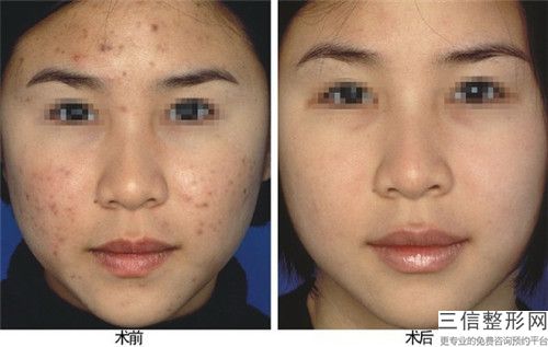 牙齦再生術治療青春痘會傷害皮膚嗎