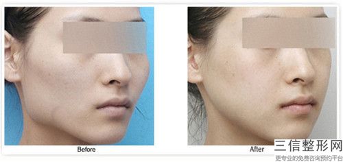 中國顴骨內推骨縫醫院推薦：顴骨內推骨縫醫院前50位測評白名單