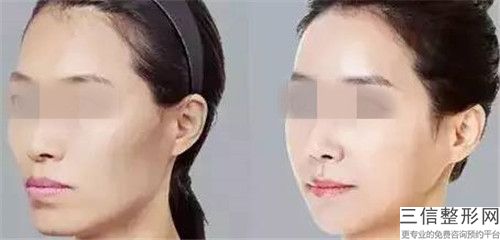 黑臉娃娃治療毛孔粗大失敗修復(fù)術(shù)適應(yīng)的人群
