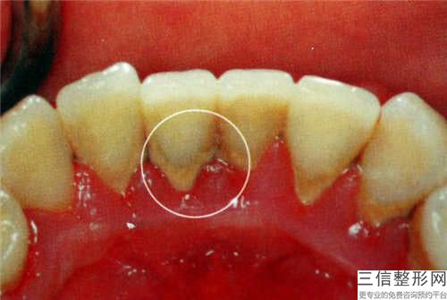 周口牙根修復手術效果及適應人群