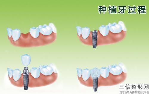 鄭州何氏醫(yī)療美容診所牙周手術(shù)治療黑三角的材料哪種比較安全