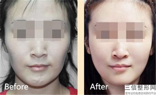 泰州正畸面弓術(shù)之后應如何護理恢復比較快