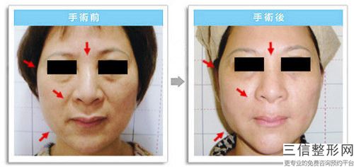 眼部除皺打針能保持到什么時候
